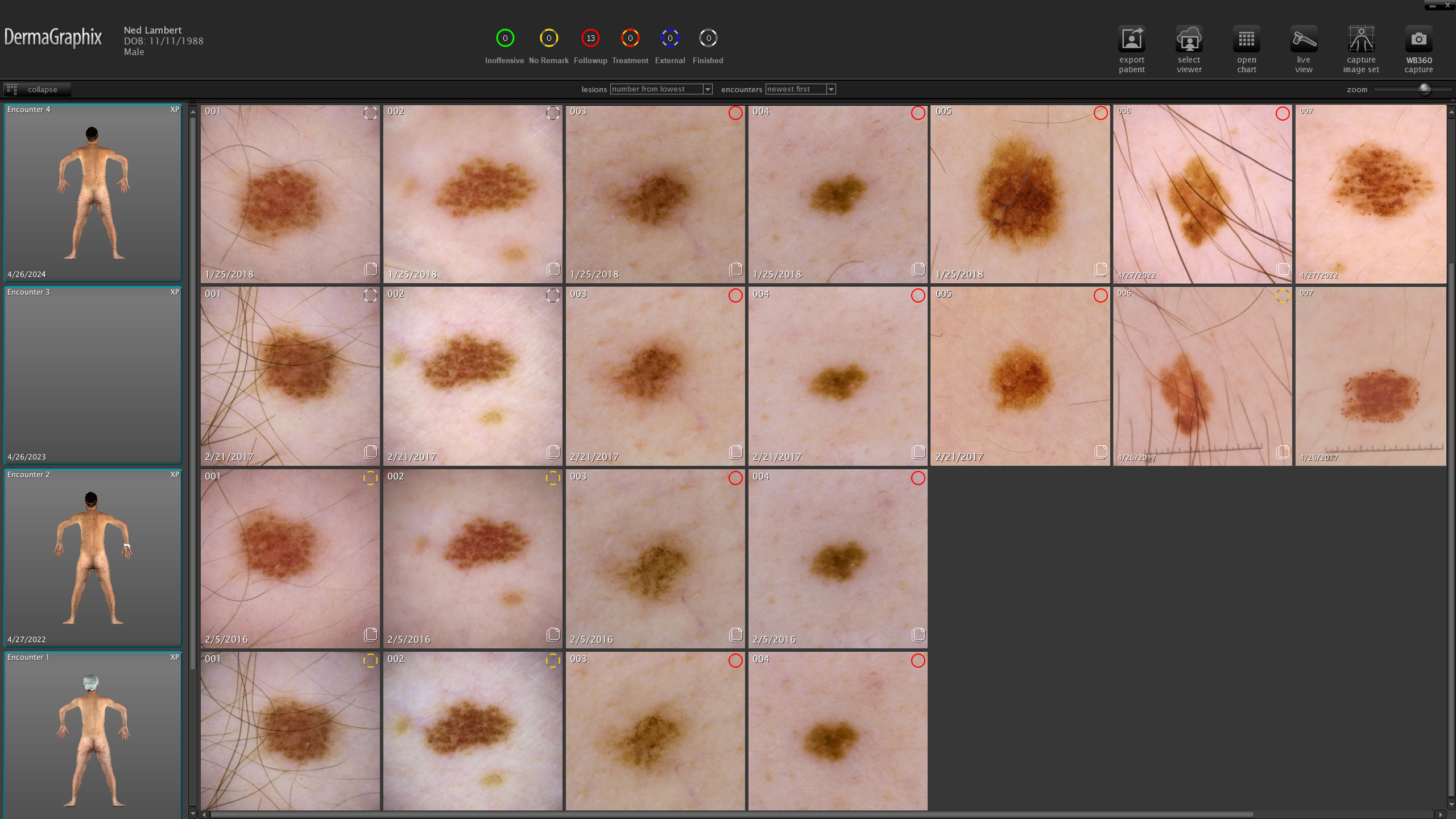 Digital Mole Mapping